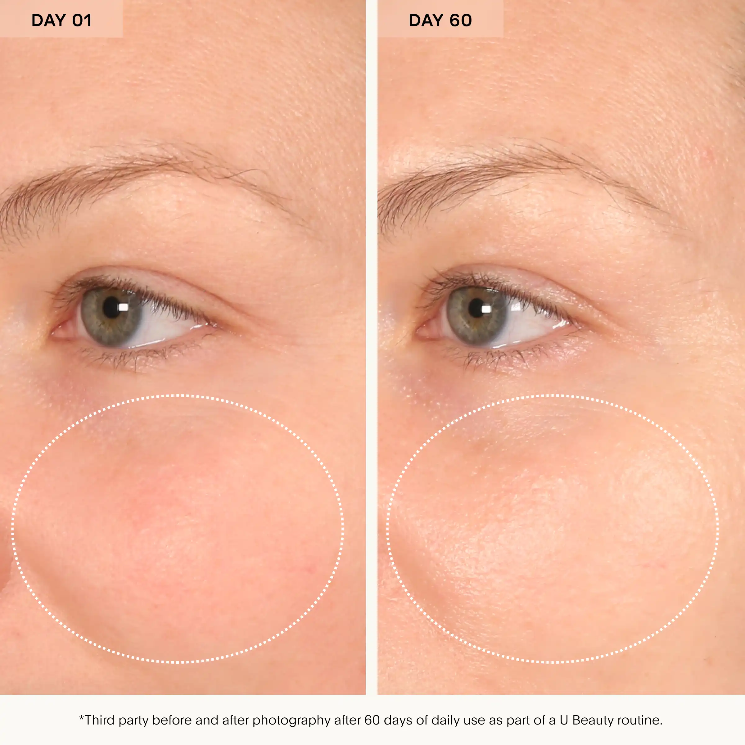 Side-by-side comparison of eye area skin showing day 1 and day 60 of treatment with reduced redness and smoother texture.