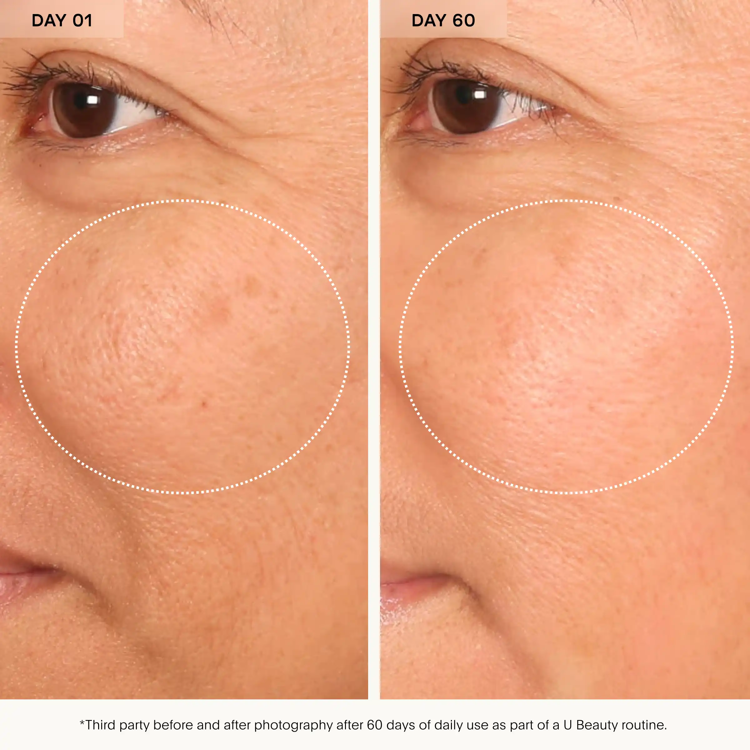 Before and after closeup of cheek and eye area showing skin texture comparison over 60 days.