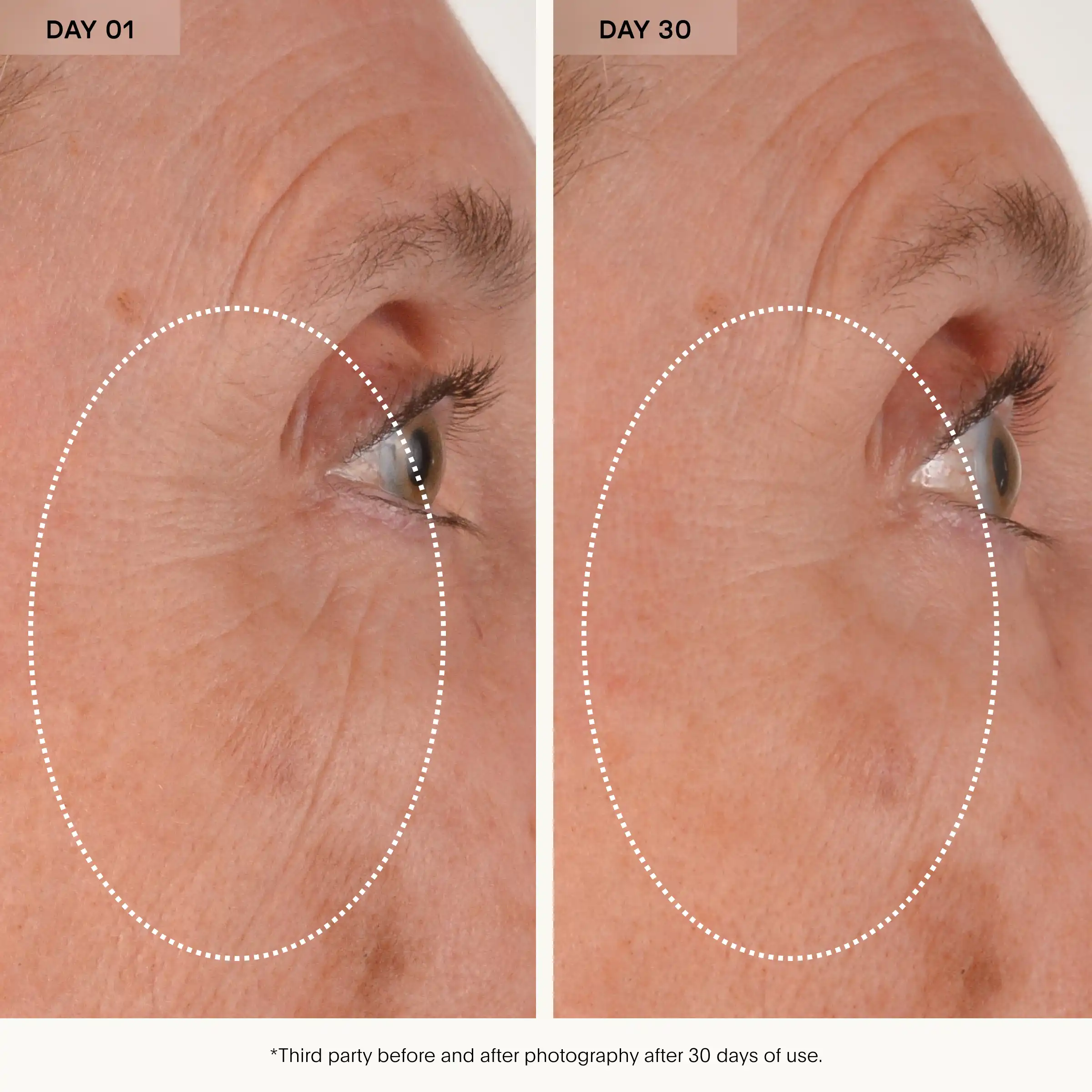 Before and after comparison of eye area showing skin texture at day 1 and day 30.