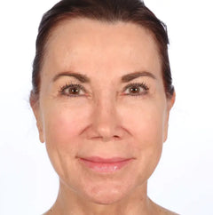 Close-up of a woman's face on Day 01 with visible skin texture before using the Resurfacing Flash Peel.