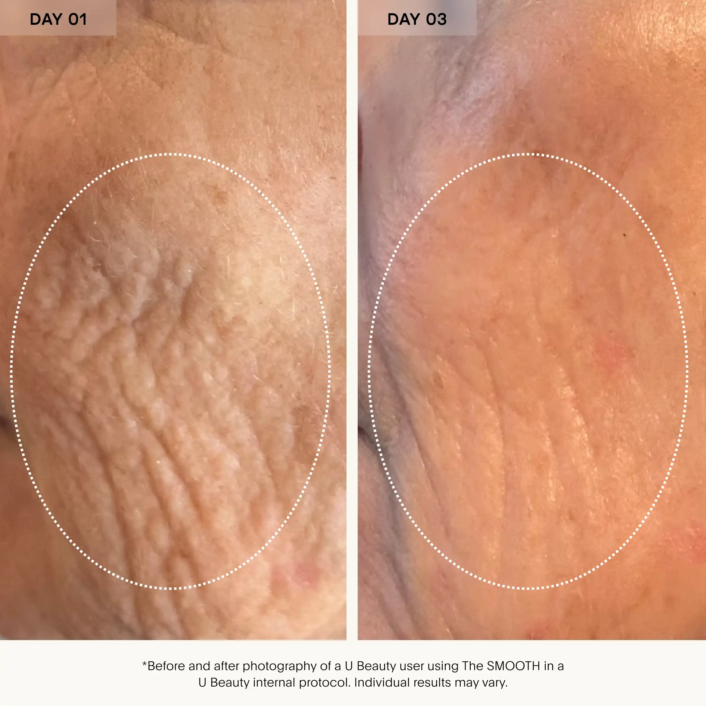 Before and after close-up skin comparison showing reduced wrinkles on day one versus day three.